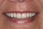 Fig 2. Smile showing more than 75% of the anterior teeth and interproximal gingiva; there is no gingival display above the anterior teeth