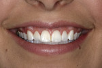 Fig 3. Smile showing about 2 mm of gingival display above the central incisors and a contiguous band of gingiva above the anterior teeth.