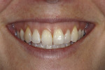 Fig 4. Smile showing more than 4 mm of gingival display above the central incisors and a contiguous band of gingiva above the anterior teeth.