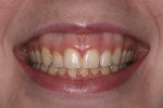Fig 5. Smile showing 7 mm or more of gingival display above all the anterior teeth.