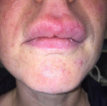 Fig 1. Upper lip enlargement with erythema.