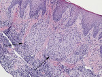 Fig 3. Hematoxylin and eosin stained section showing numerous granulomas composed of epithelioid histiocytes mixed with multinucleated giant cells and a diffuse infiltrate of lymphocytes and plasma cells (100x magnification).