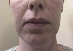Fig 4. Improvement of lip swelling after triamcinolone intralesional injection.