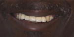 Fig 6. Analysis of the patient’s smile; frontal view before (Fig 6) and after (Fig 7) the interdisciplinary treatment was provided.