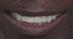 Fig 7. Analysis of the patient’s smile; frontal view before (Fig 6) and after (Fig 7) the interdisciplinary treatment was provided.