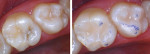 Fig. 1. Pre- and post-treatment photographs
of PRR restorations by Dr. Kanuga