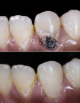 Fig 1. Restoration using Activa Presto with
Crysta MCP technology (images
courtesy of Priti Lamba, BDS)