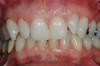 Figure 16  Replacement of the maxillary lateral incisor with a CAD/CAM zirconium abutment and a zirconium/ceramic crown.