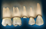 Figure 1  A patient presents with a single-rooted tooth that has lost coronal structure to the crestal margin of bone.