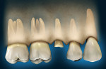 Figure 3  An alternate treatment option to achieve a ferrule without affecting the osseous levels on the adjacent teeth is forced eruption of the affected tooth.