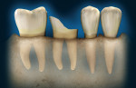 Figure 5  Osseous crown lengthening to achieve a ferrule requires recontouring of the supporting bone on the adjacent teeth, possibly leading to furcation exposure on the affected or adjacent teeth.