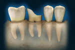 Figure 6  Forced eruption of multi-rooted teeth can lead to exposure of the furcation and complicate patient home care and long-term survivability of the tooth.