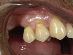 The old composite restorations were removed, and the enamel margins of the preparations were slightly beveled with coarse and fine diamond burs.