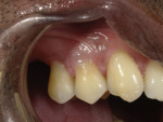 The violet and dark pink shades of a gingival colored universal composite system were mixed in a 3:1 proportion and added to the restoration on tooth No. 5 to improve the gingival symmetry.