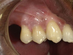 Posttreatment retracted close-up photograph showing the final results. Note how the shade achieved by mixing the gingival composites closely matches the natural gingival shade of the patient.