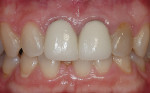 Figure 4  The single dark lateral incisor after endodontic treatment can be bleached both inside and outside for best results with minimum appointments and risk of side effects.
