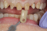Fig 6. The prepared teeth are photographed along with a shade tab to communicate the stump color to the laboratory.