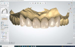 Fig 12. The scan of the provisional restorations is used as a guide to design the shape, form, and position of the final restorations. By superimposing the scan of the temporary restorations over the scan of the preparations to align and create the final design, the ceramist is able to preview how the case will appear in facial context.