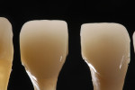 Fig 17. The final stained and glazed restorations exhibited a natural level of translucency and a seamless gradient transition from dentin to enamel.