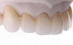 Fig 18. The final stained and glazed restorations exhibited a natural level of translucency and a seamless gradient transition from dentin to enamel.