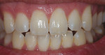 Figure 6  The preoperative examination is important to prepare the patient for realistic expectations, and reveals faint white spotting with baseline tooth discoloration.