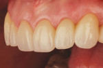 Fig 22. Post-treatment close-up views of the final restorations.
