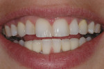 Figure 11  One problem with OTC products is that they do not allow a proper examination by a dentist before bleaching. The patient did not realize where the composite restorations closing the spaces between her teeth were located, and that the restor
