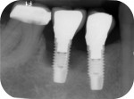Fig 1. Note more than 50% bone loss around implant No. 30 and approximately 15% bone loss around implant No. 29 (July 2012).