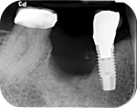 Fig 2. Radiograph taken in 2016 showing bone defect approximately 2 years after implant No. 30 dislodged in December 2014 during regular function.