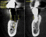 Fig 6. Defect dimensions and ridge deficiencies measured on preoperative CBCT on sites Nos. 30 (left) and 29 (right).