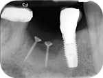 Fig 10. Periapical radiograph 24 weeks after GBR with tenting screws, particulated FDBA, and a collagen membrane. Mild resorption of most coronal particles can be observed.