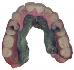 Fig 4 and Fig 5. Intraoral surface scans with the patient’s removable partial denture in place; frontal view (Fig 4), occlusal view (Fig 5).