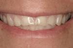Figure 1  A 45-year-old patient presented with worn, sensitive teeth resulting from bulimia.
