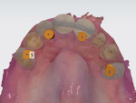 Fig 11 and Fig 12. The CBCT and virtual wax-up plan were merged together, and virtual implant placement was done; frontal view (Fig 11), occlusal view (Fig 12).