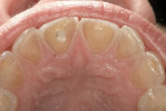 Figure 2  The teeth exhibited a favorable color, so a translucent restorative material could be used.