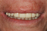 Fig 22. The zirconia provisional restoration replicated the patient’s pretreatment restoration.