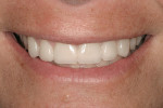 Figure 3  Final restorations were achieved with minimal reduction on the facial and lingual aspects.