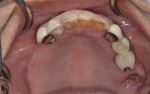 Fig 2. Intraoral view of the maxillary arch. Note the ovoid arch form and fractured crown No. 14.