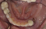 Fig 3. Intraoral view of the mandibular arch. Note the root tip in site No. 21.