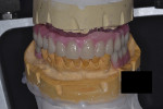 Fig 6. Wax try-in. Artificial tooth arrangement was tried in the patient’s mouth to ascertain esthetics and occlusion.