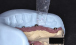 Fig 7. Silicone index for space analysis to help determine the restorative space. A measurement was made from the platform of the abutment to the occlusal plane using the silicone index that was made from the wax try-in.