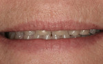Figure 5  A 50-year-old patient presented with extensive wear on all her teeth due to gastric reflux.