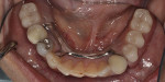 Fig 13. Intraoral view of mandibular prosthesis showing the implant-assisted RPD without the need for clasps.
