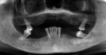 Fig 1. Panoramic reconstruction from initial CBCT.