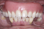 Fig 2. Initial presentation showing maxillary acrylic prosthesis opposing periodontally compromised mandibular teeth.