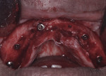 Fig 3. Placement of five maxillary BLX implants following alveoloplasty.