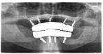 Fig 8. Panoramic x-ray showing BLX implants and final zirconia prostheses.