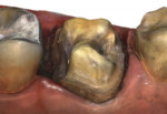 Fig 3. Significantly subgingival margin able to be digitally scanned with IOS because of good retraction and isolation.