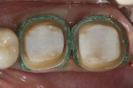 Fig 5. Two retraction cords placed with the larger second cord providing lateral retraction of the gingiva.