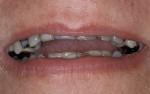 Figure 9  A 65-year-old patient presented with worn dentition.